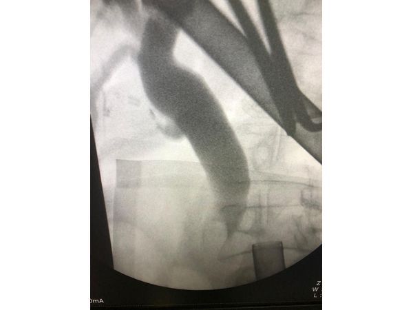 Крупный конкремент в дистальном отделе холедоха на интраоперационной фистулографии