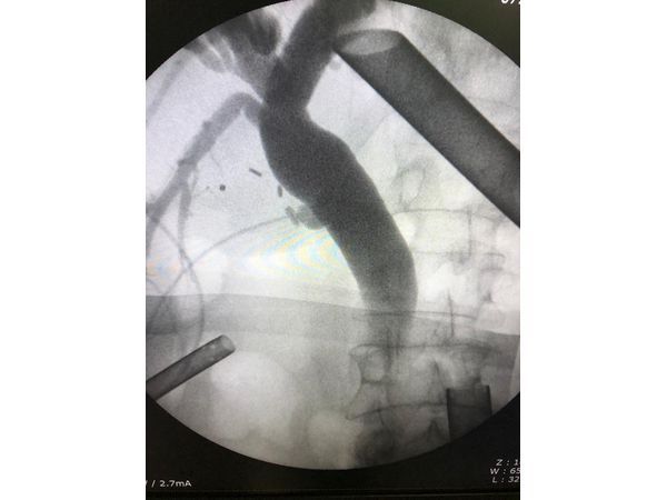 Контрольная фистулография после извлечения конкремента из холедоха