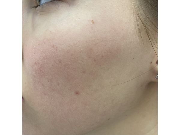 Через 11 месяцев после лечения