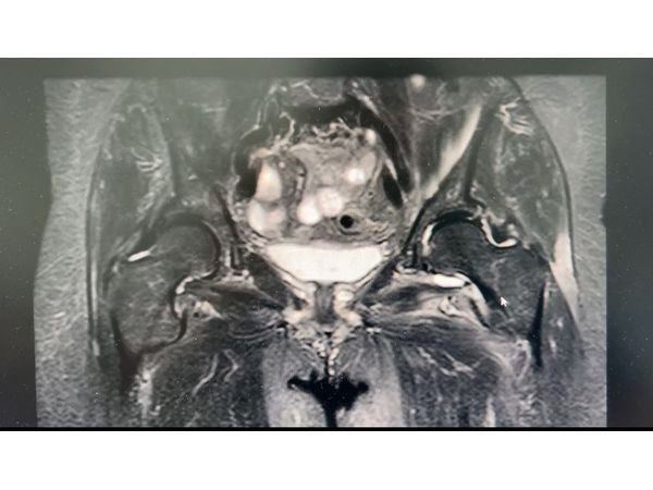 МРТ левого тазобедренного сустава (вид спереди)