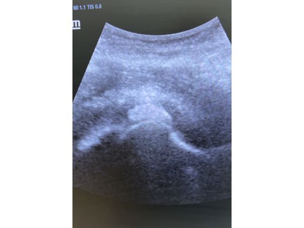 Вид образования на УЗИ