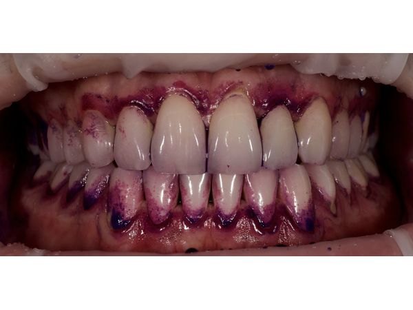 Диагностика гигиены полости рта