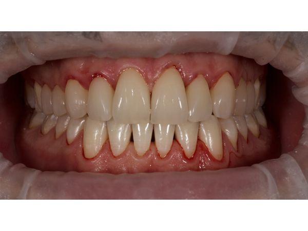 Сразу после лечения