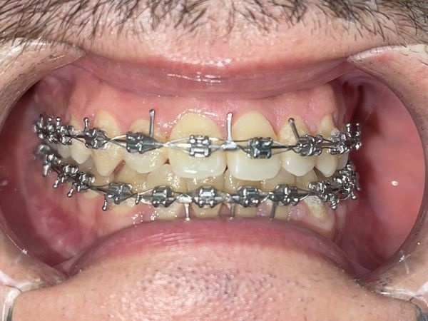 После операции