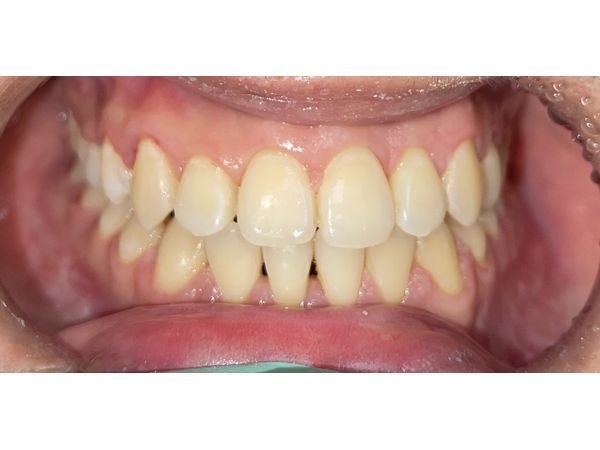 После снятия брекетов 