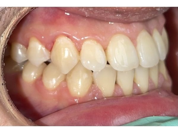 После снятия брекетов 