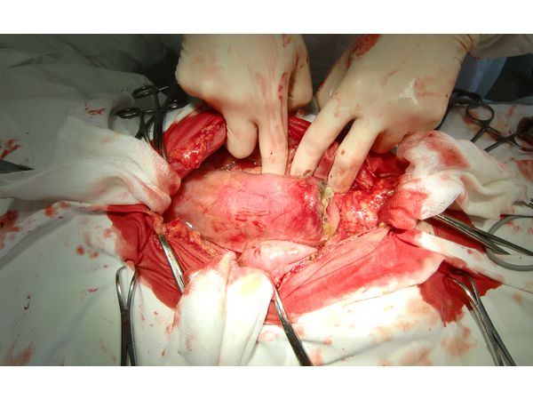 Инородное тело в просвете тонкой кишки Инородное тело в просвете тонкой кишки