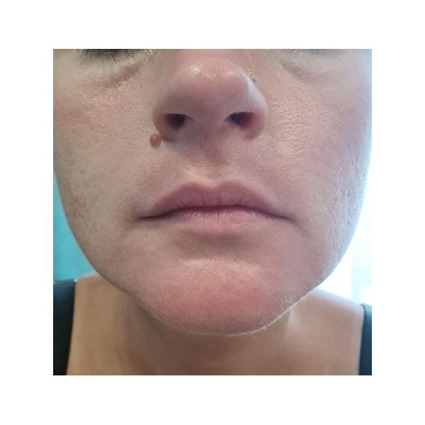 Кожа после окончания лечения