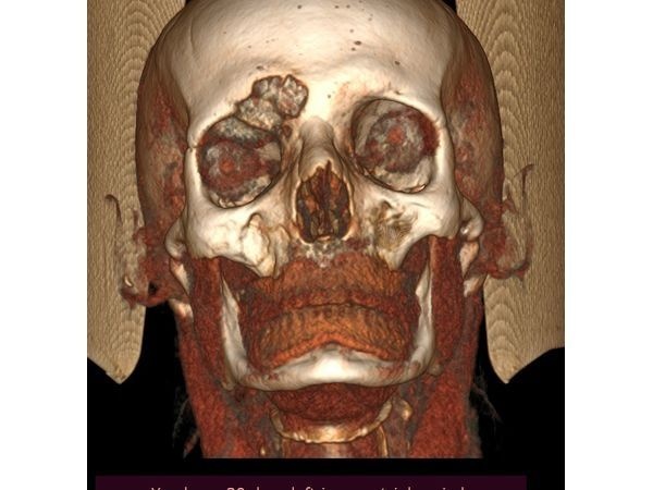 Дефект лобной пазухи справа, смещение правого глазного яблока 