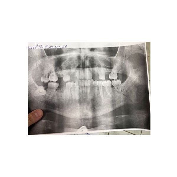 Панорамный снимок челюсти