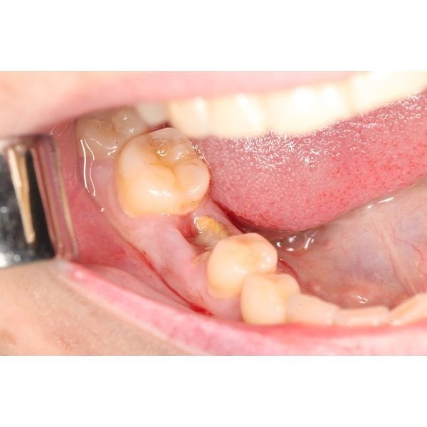 Разрушенный зуб перед операцией Разрушенный зуб перед операцией