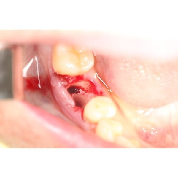 После удаления зуба После удаления зуба