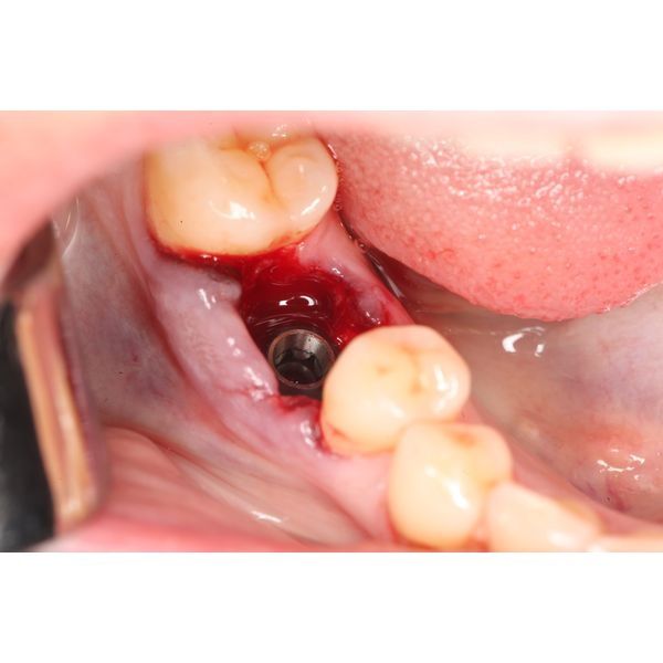 Установка имплантата Установка имплантата