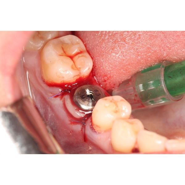 Установка формирователя десны и наложение швов Установка формирователя десны и наложение швов