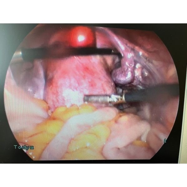 Удаление миомы Удаление миомы