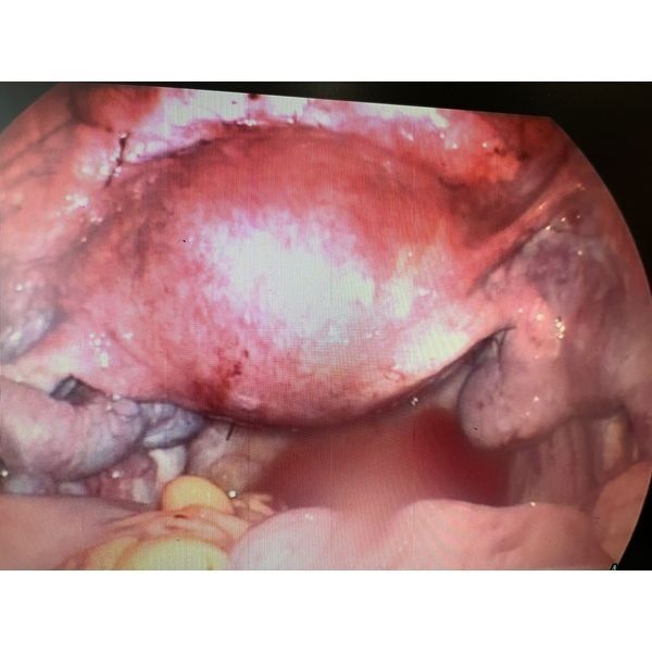 Узел с основанием в мышечном слое Узел с основанием в мышечном слое