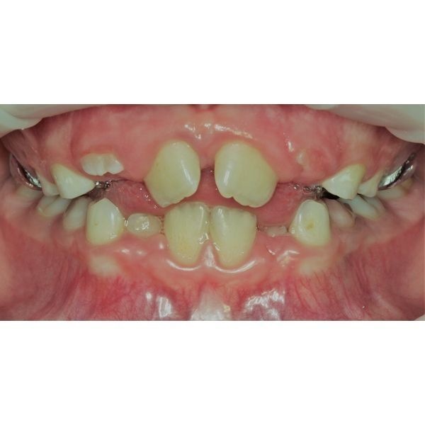 Через 2 недели после начала лечения