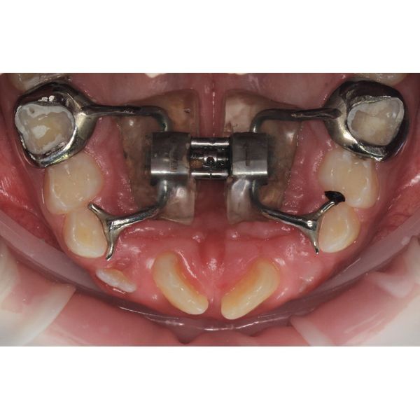 Через 2 недели после фиксации аппарата