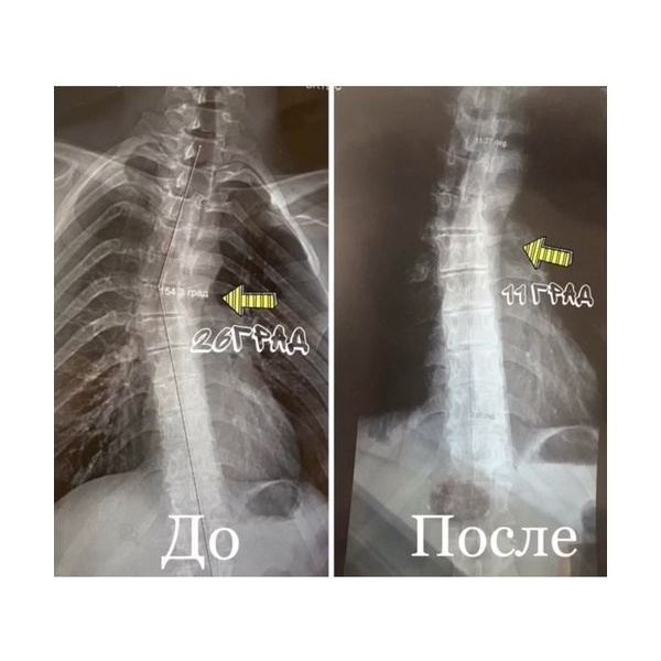 Динамика лечения сколиоза у пациента