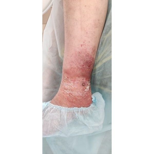 Перед операцией Перед операцией