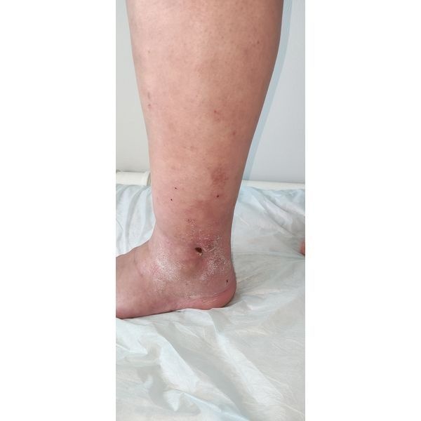 Через месяц после операции Через месяц после операции