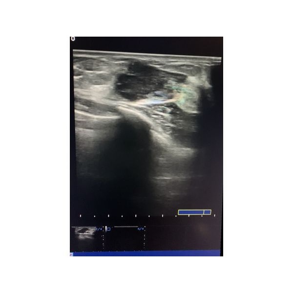 УЗ-снимок образования УЗ-снимок образования