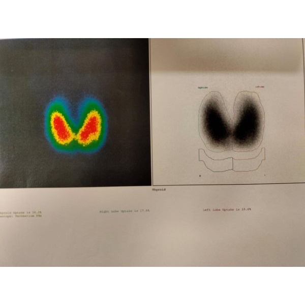 Сцинтиграфия щитовидной железы с Тс-пертехнетатом Сцинтиграфия щитовидной железы с Тс-пертехнетатом