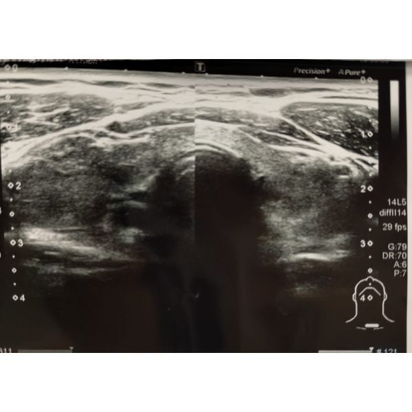 УЗИ щитовидной железы УЗИ щитовидной железы