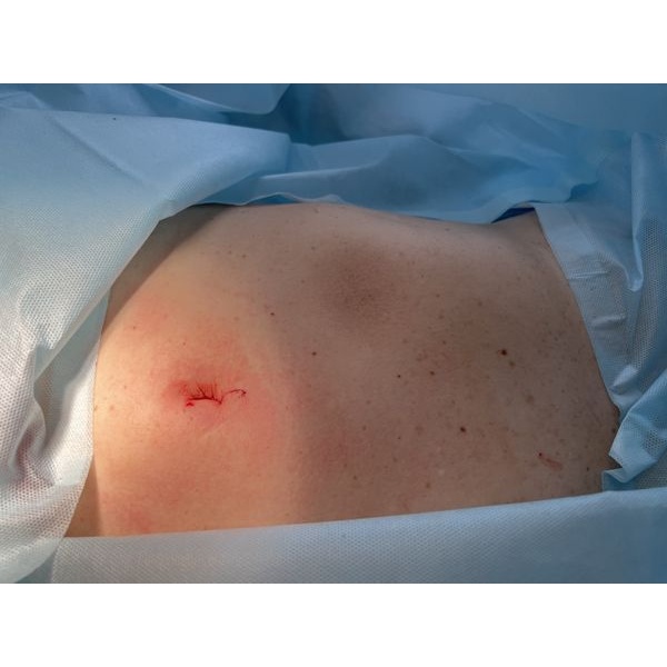 Ушитая рана после операции