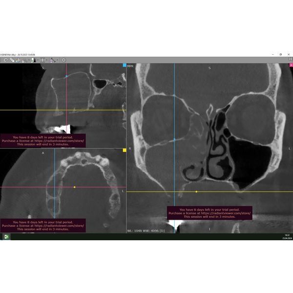 КТ пациентки до лечения КТ пациентки до лечения