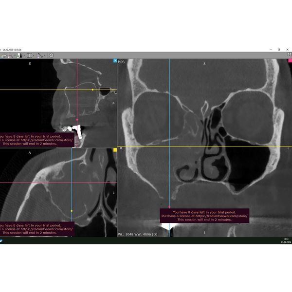 КТ пациентки до лечения КТ пациентки до лечения