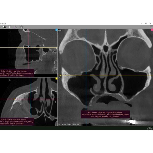 КТ пациентки после лечения КТ пациентки после лечения