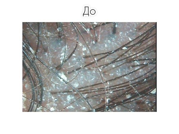 Трихоскопия на первом приёме