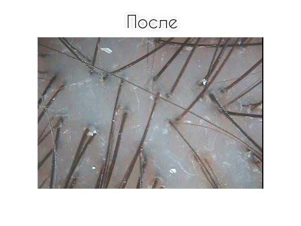 Трихоскопия через 1,5 месяца лечения 
