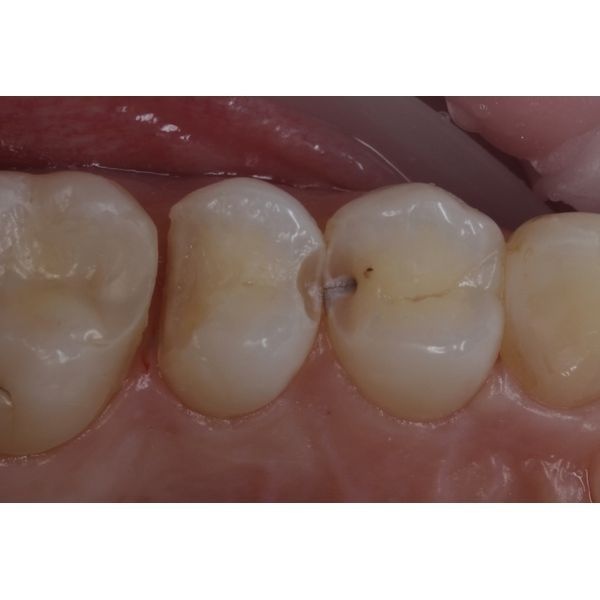 Скрытый кариес Скрытый кариес