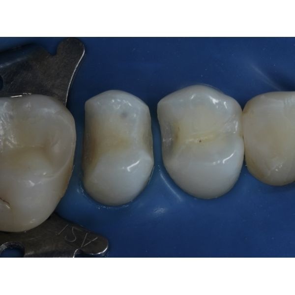 Полное удаление кариеса Полное удаление кариеса