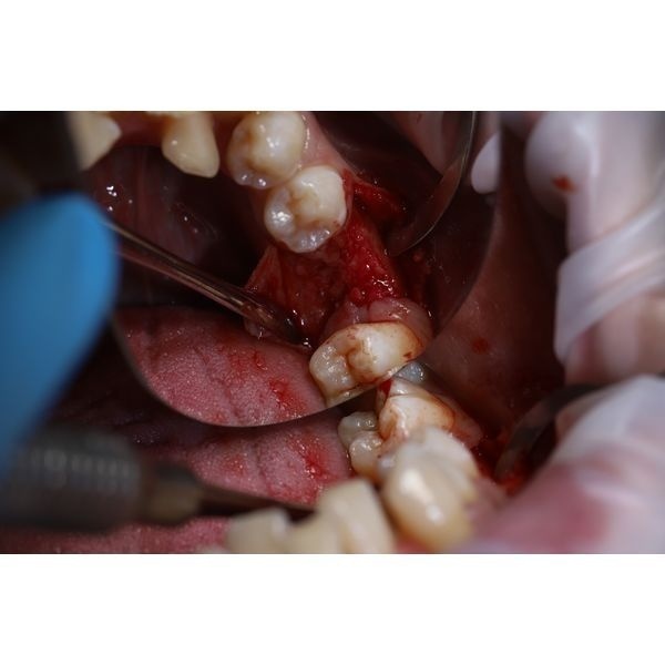 Откинут слизисто-надкостничный лоскут