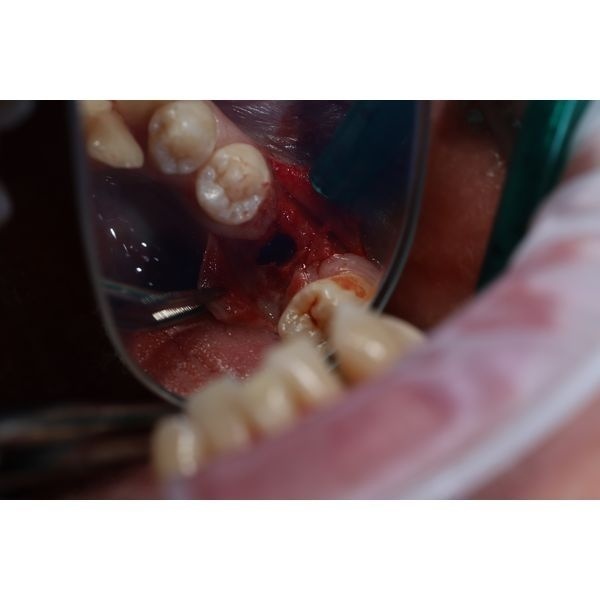 Сформировано имплантационное ложе