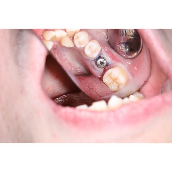 Постановка имплантата и формирователя десны