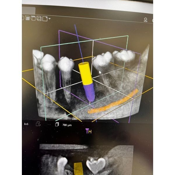 Планирование имплантации