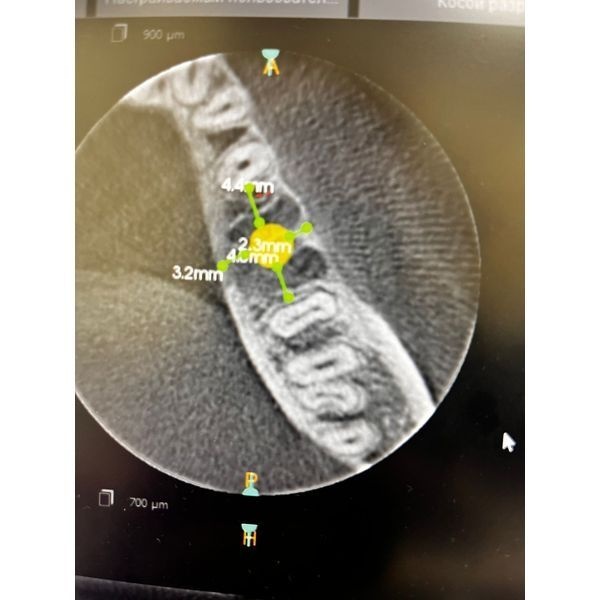Планирование имплантации