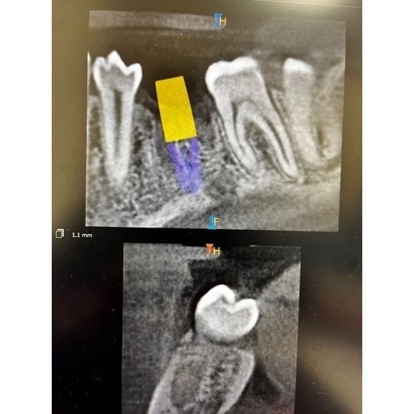 Планирование имплантации