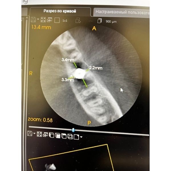 КТ после постановки имплантата