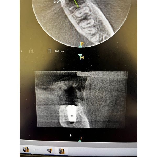 КТ после процедуры