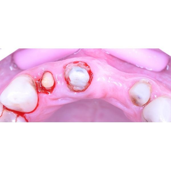 Разрушенные зубы Разрушенные зубы