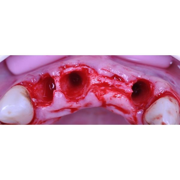 Удаление разрушенных зубов Удаление разрушенных зубов