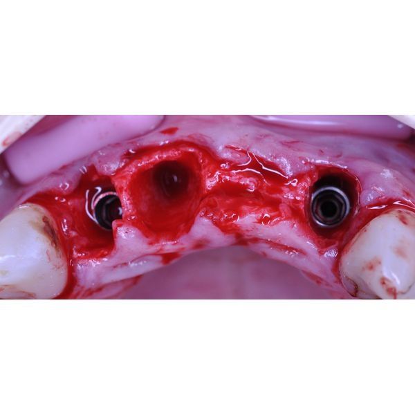 Установка имплантатов в раны Установка имплантатов в раны