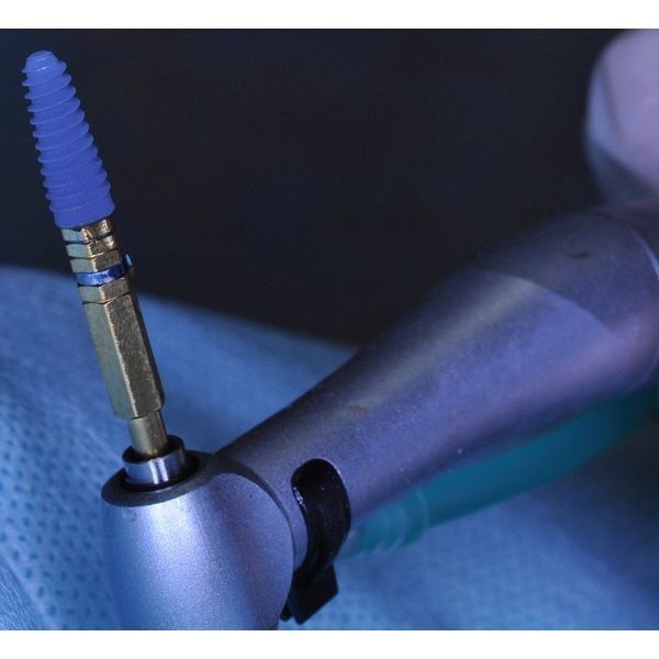 Имплантат Имплантат