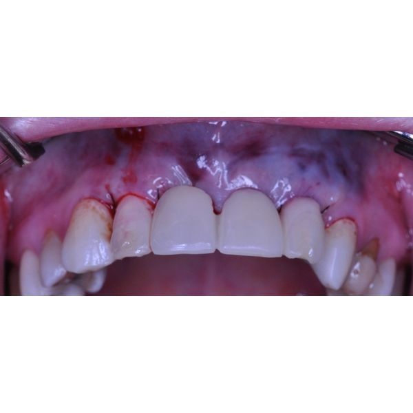 Временный пластмассовый протез на имплантатах Временный пластмассовый протез на имплантатах