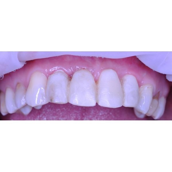 Временный пластмассовый протез Временный пластмассовый протез